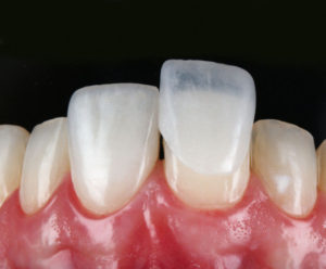 Lentes de contato na Odontologia
