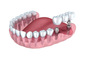 Prótese fixa de 3 elementos sobre implantes