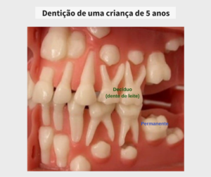 Aos 5 anos de idade a criança ainda não possui nenhum dente permanente irrompido
