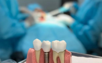 Quem não pode fazer um Implante Dentário?