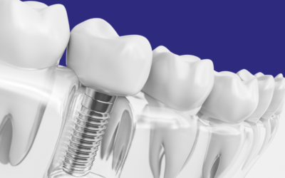 Rejeição de Implante Dentário: Mito ou Verdade?