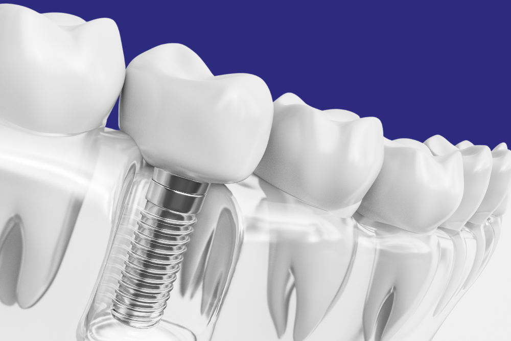 Rejeição de Implante Dentário: Mito ou Verdade?
